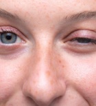 מיאסטניה גרביס